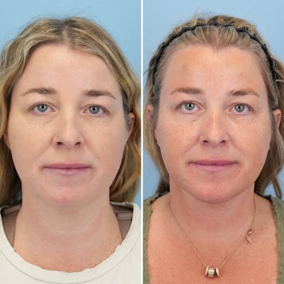 Facelift Before & After Gallery - Patient 247352 - Image 1
