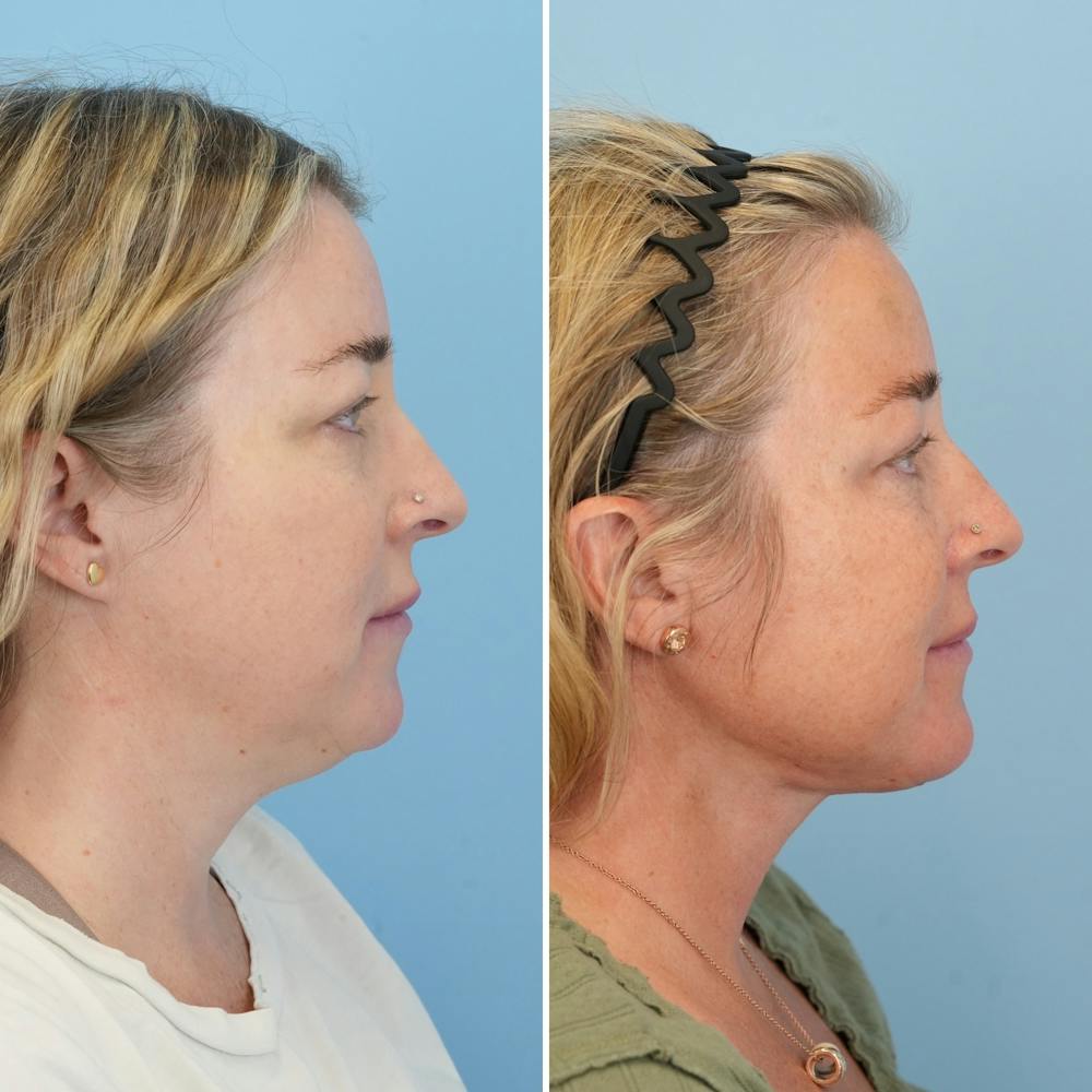 Facelift Before & After Gallery - Patient 247352 - Image 3