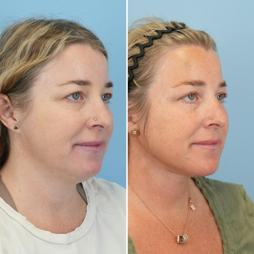 Facelift Before & After Gallery - Patient 247352 - Image 2