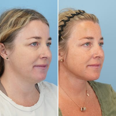 Facelift Before & After Gallery - Patient 247352 - Image 2