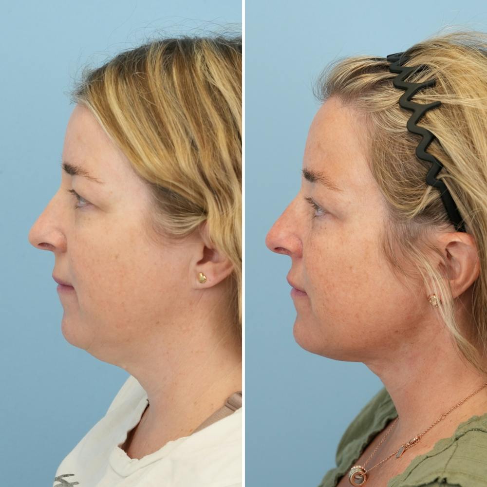 Facelift Before & After Gallery - Patient 247352 - Image 5