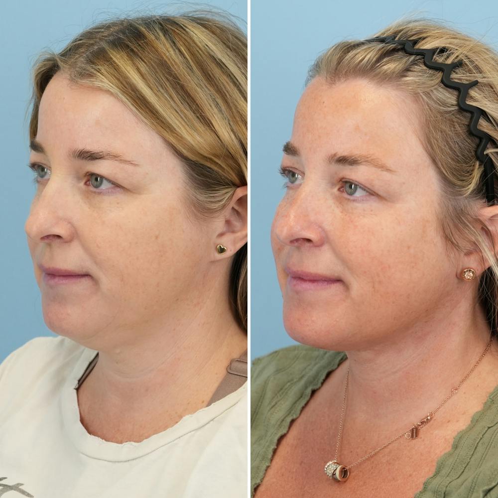 Facelift Before & After Gallery - Patient 247352 - Image 4
