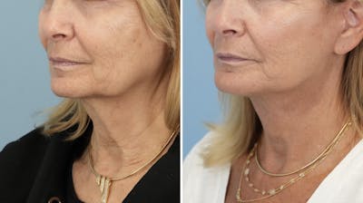Facelift Before & After Gallery - Patient 246307 - Image 4