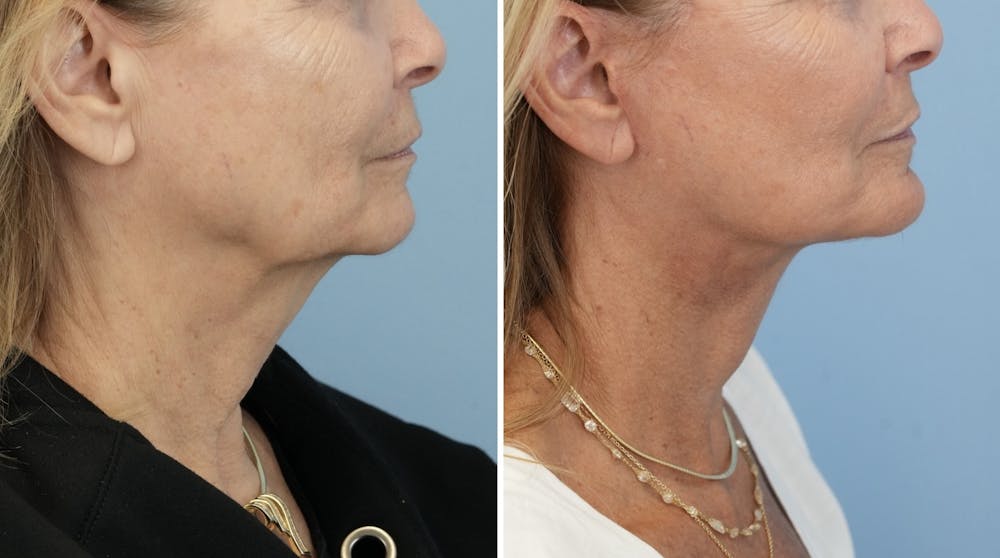 Facelift Before & After Gallery - Patient 246307 - Image 3