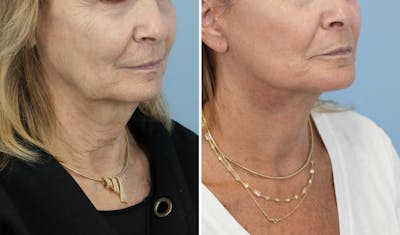 Facelift Before & After Gallery - Patient 246307 - Image 2