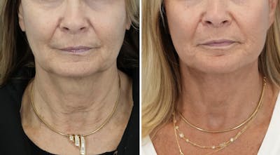 Facelift Before & After Gallery - Patient 246307 - Image 1
