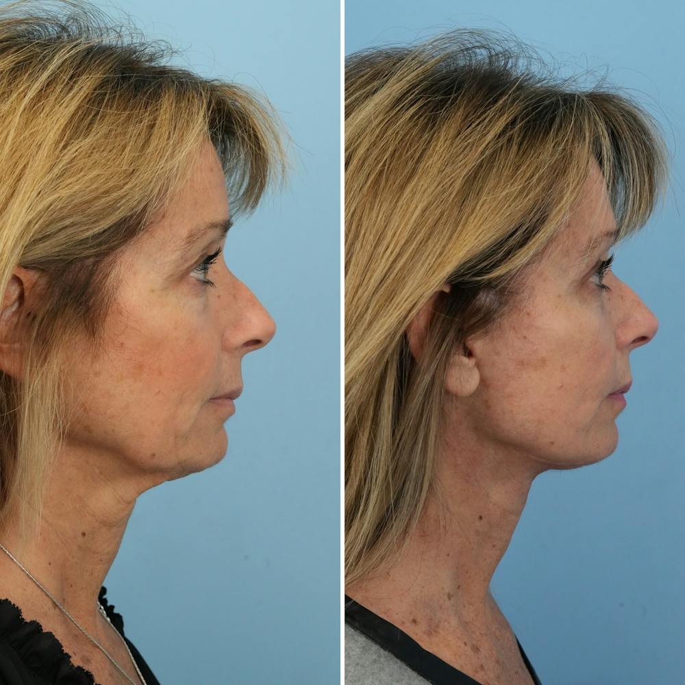 Facelift Before & After Gallery - Patient 324146 - Image 4