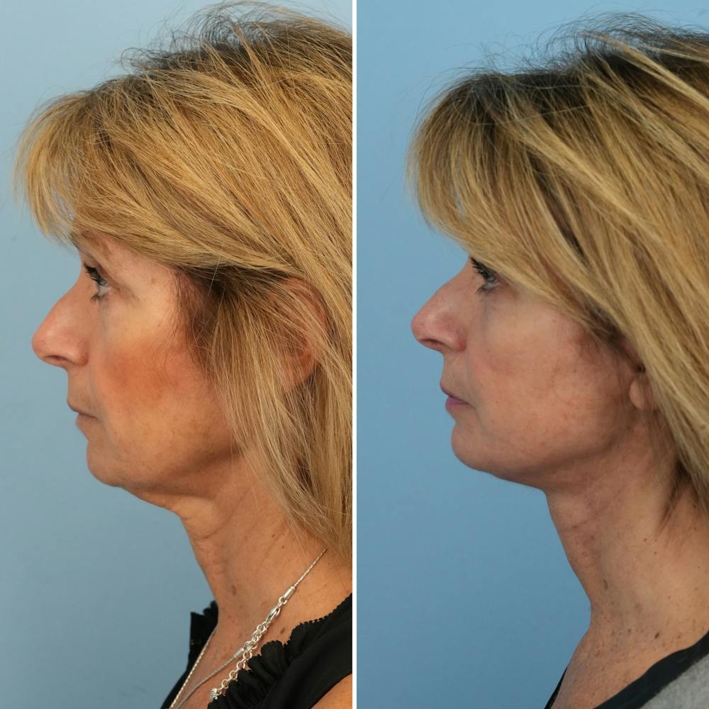 Facelift Before & After Gallery - Patient 324146 - Image 2