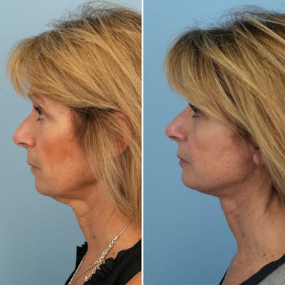 Facelift Before & After Gallery - Patient 324146 - Image 2