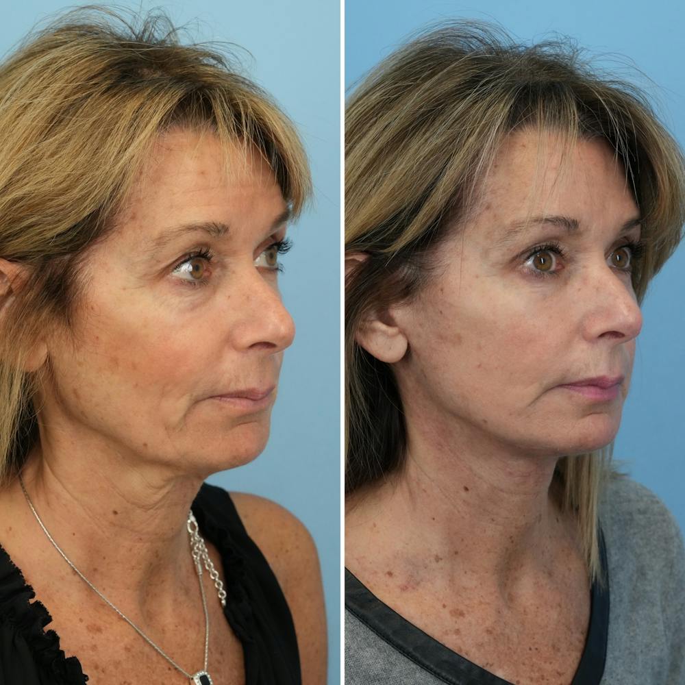 Facelift Before & After Gallery - Patient 324146 - Image 3