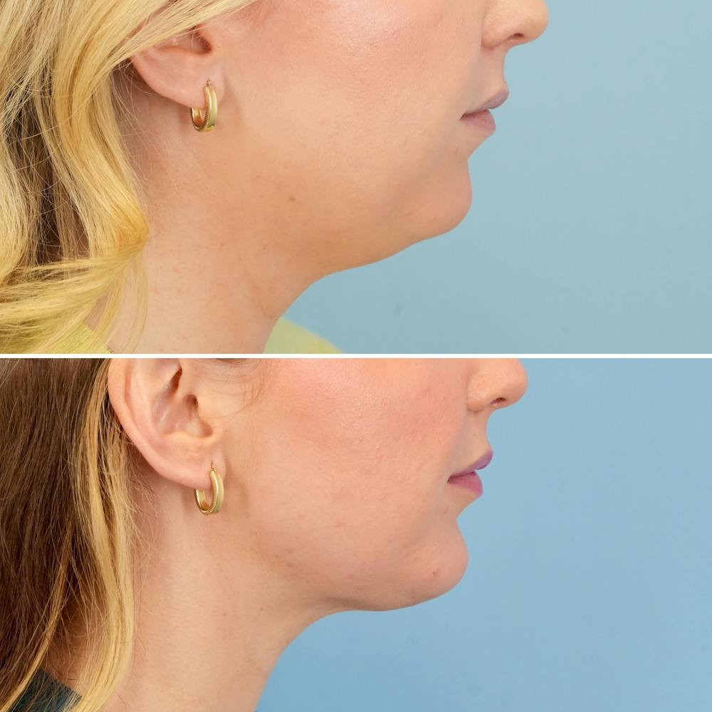 Chin Implant Before & After Gallery - Patient 613772 - Image 3