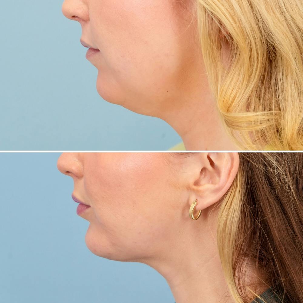 Chin Implant Before & After Gallery - Patient 613772 - Image 5
