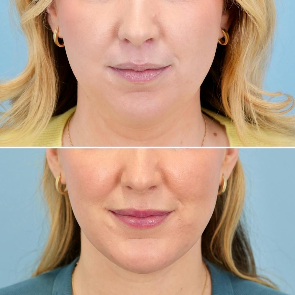 Chin Implant Before & After Gallery - Patient 613772 - Image 1