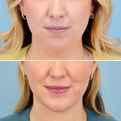 Chin Implant Before & After Gallery - Patient 613772 - Image 1