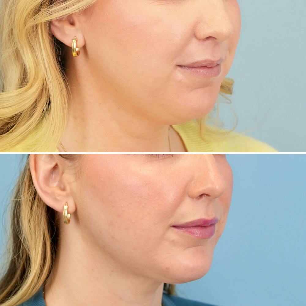 Chin Implant Before & After Gallery - Patient 613772 - Image 2