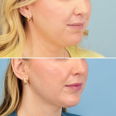 Chin Implant Before & After Gallery - Patient 613772 - Image 2