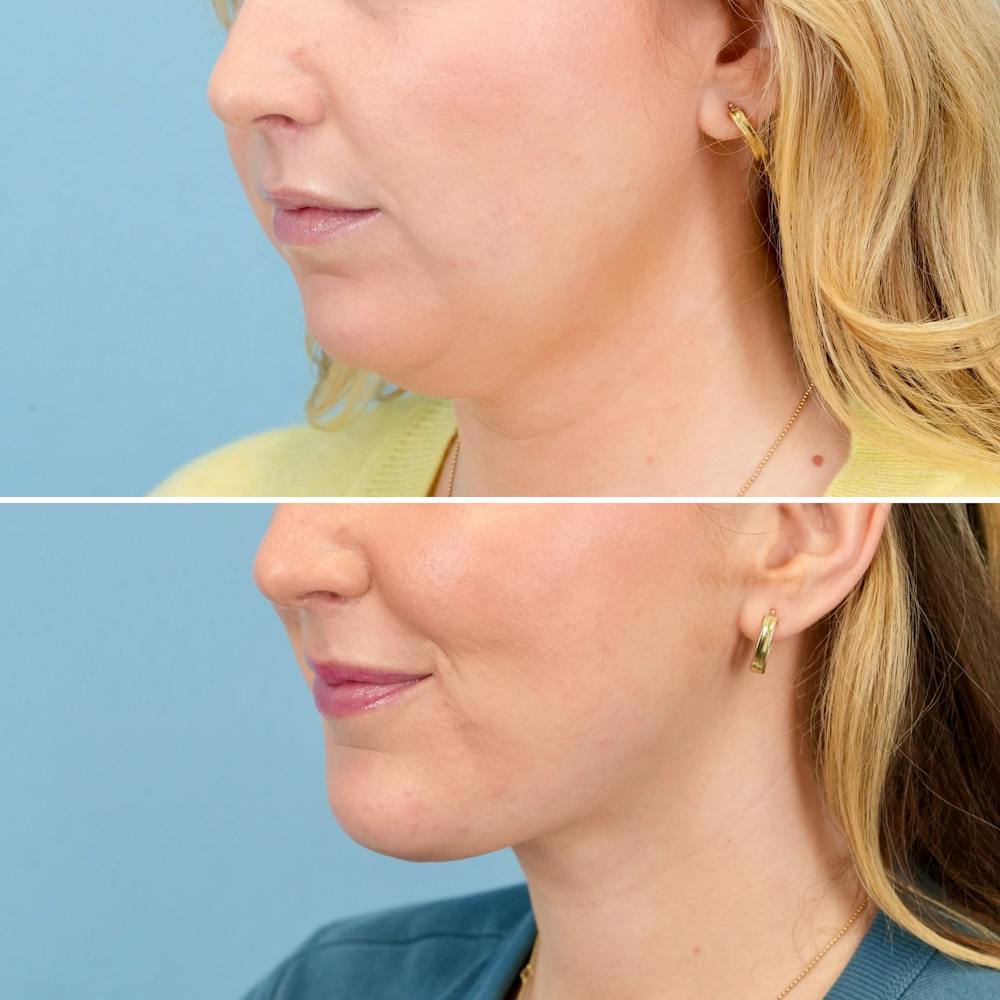 Chin Implant Before & After Gallery - Patient 613772 - Image 4
