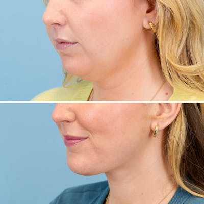 Chin Implant Before & After Gallery - Patient 613772 - Image 4
