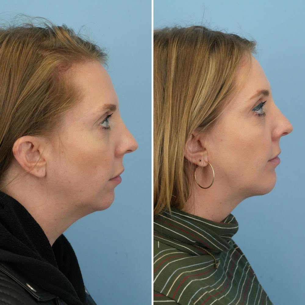 Chin Implant Before & After Gallery - Patient 360794 - Image 3