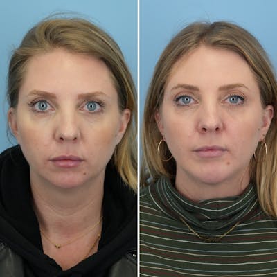 Chin Implant Before & After Gallery - Patient 360794 - Image 1