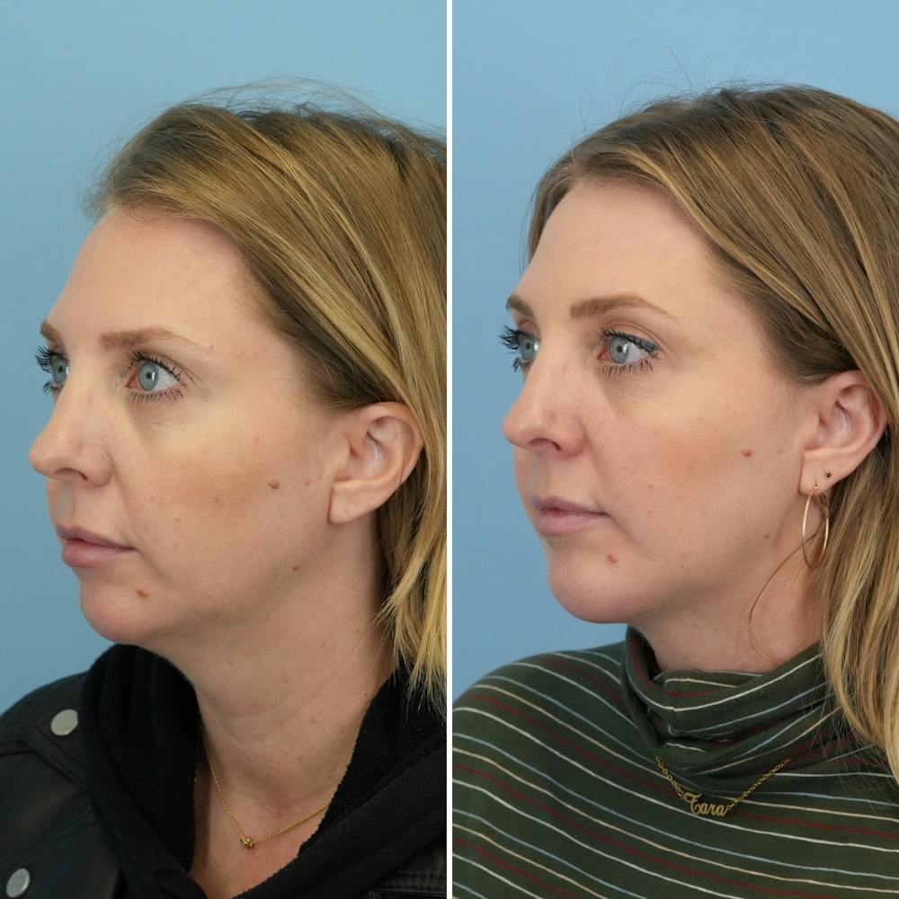 Chin Implant Before & After Gallery - Patient 360794 - Image 4