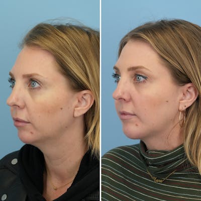 Chin Implant Before & After Gallery - Patient 360794 - Image 4