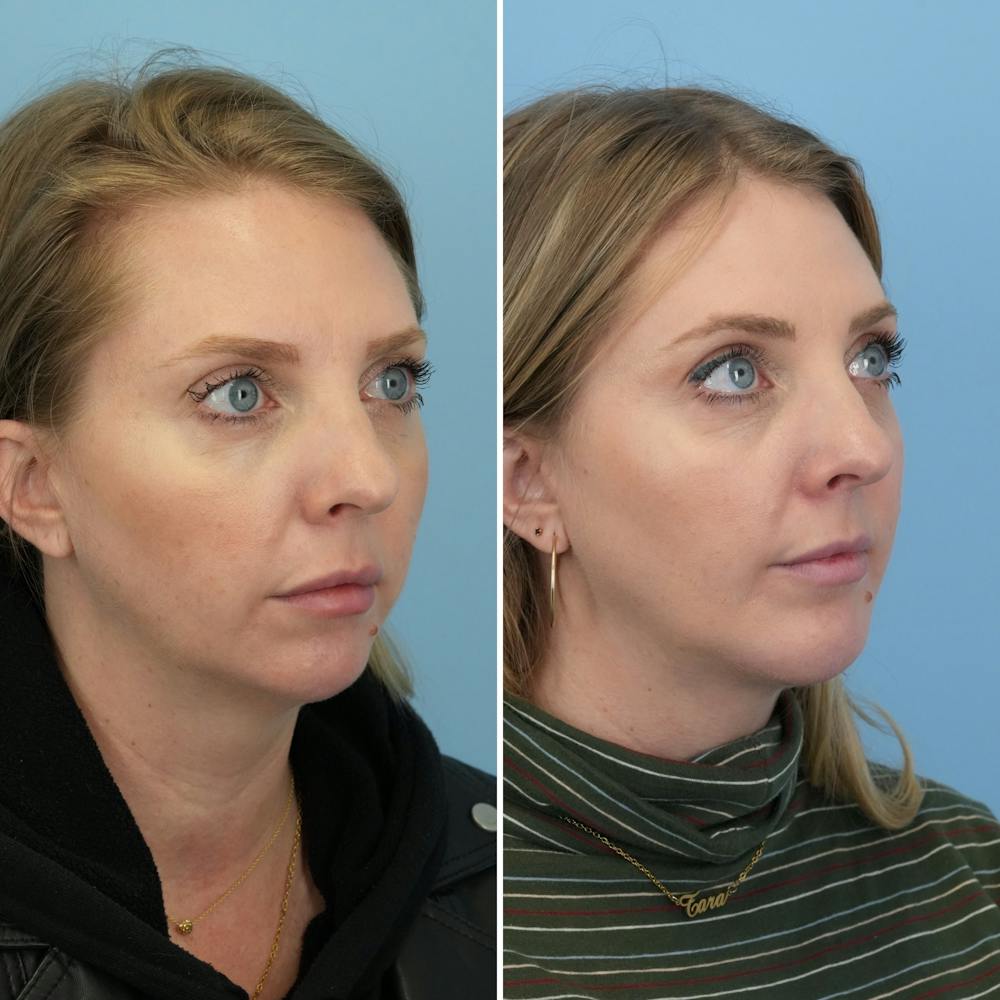 Chin Implant Before & After Gallery - Patient 360794 - Image 2