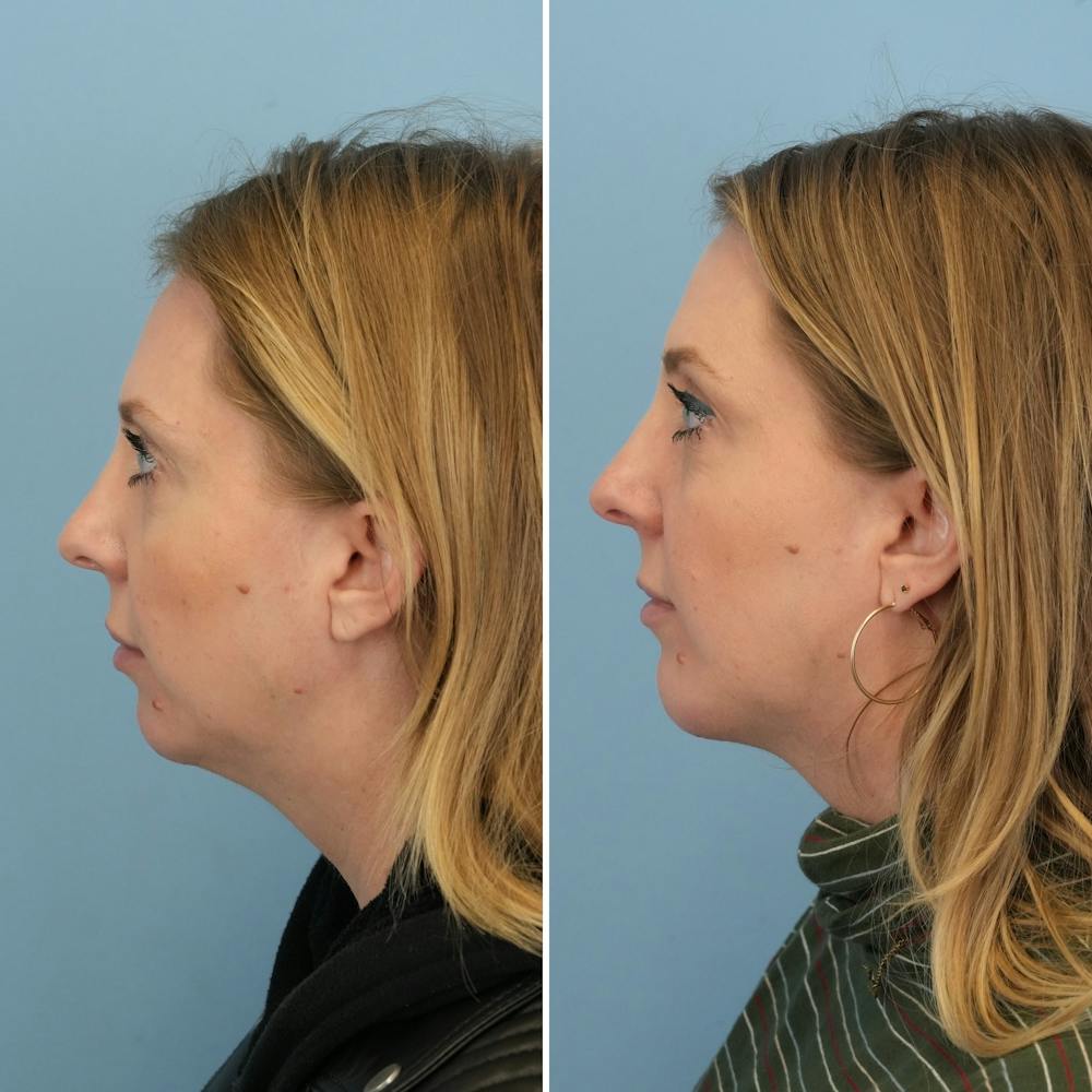 Chin Implant Before & After Gallery - Patient 360794 - Image 5