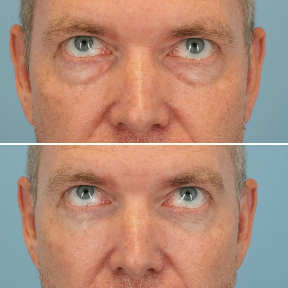 Blepharoplasty Before & After Gallery - Patient 145624 - Image 2