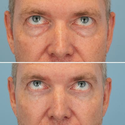 Blepharoplasty Before & After Gallery - Patient 145624 - Image 2