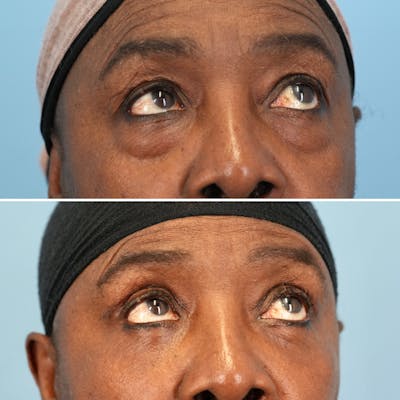 Blepharoplasty Before & After Gallery - Patient 139445 - Image 4