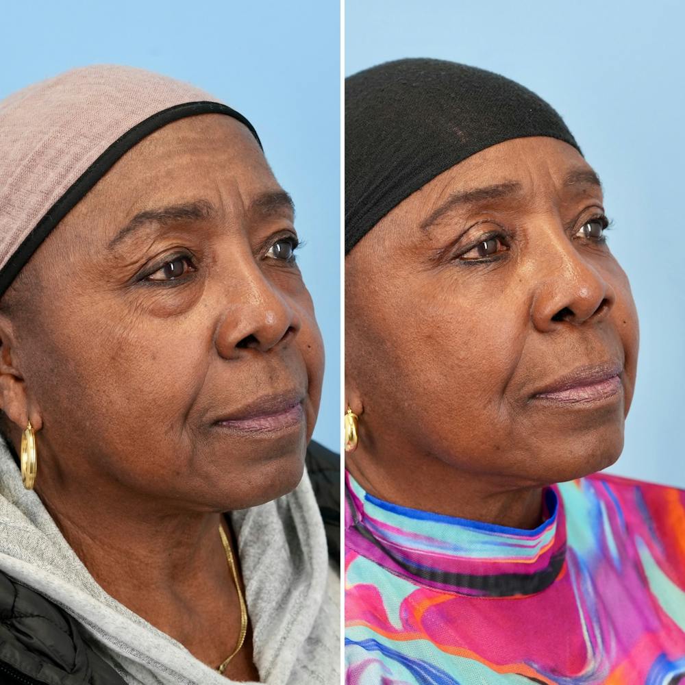 Blepharoplasty Before & After Gallery - Patient 139445 - Image 8