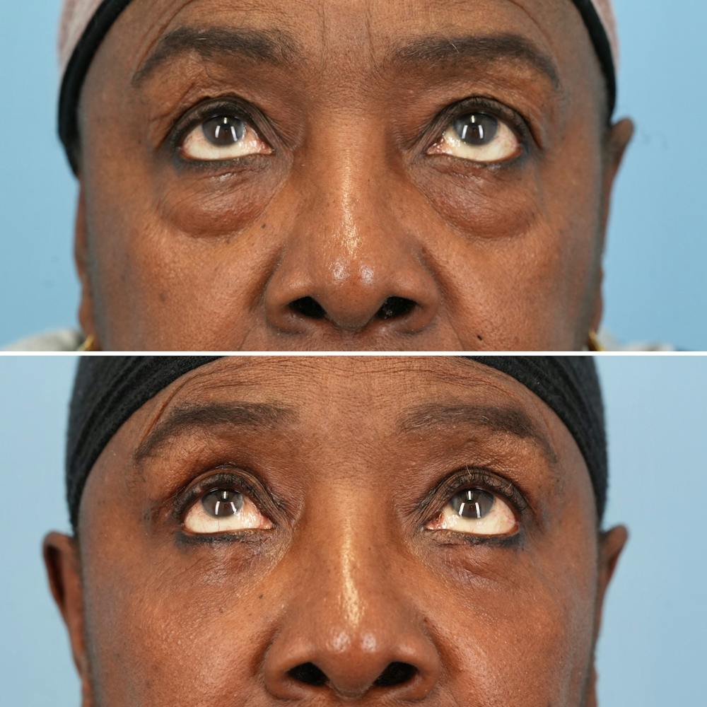 Blepharoplasty Before & After Gallery - Patient 139445 - Image 3