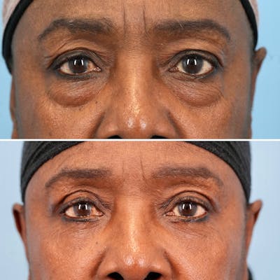 Blepharoplasty Before & After Gallery - Patient 139445 - Image 2