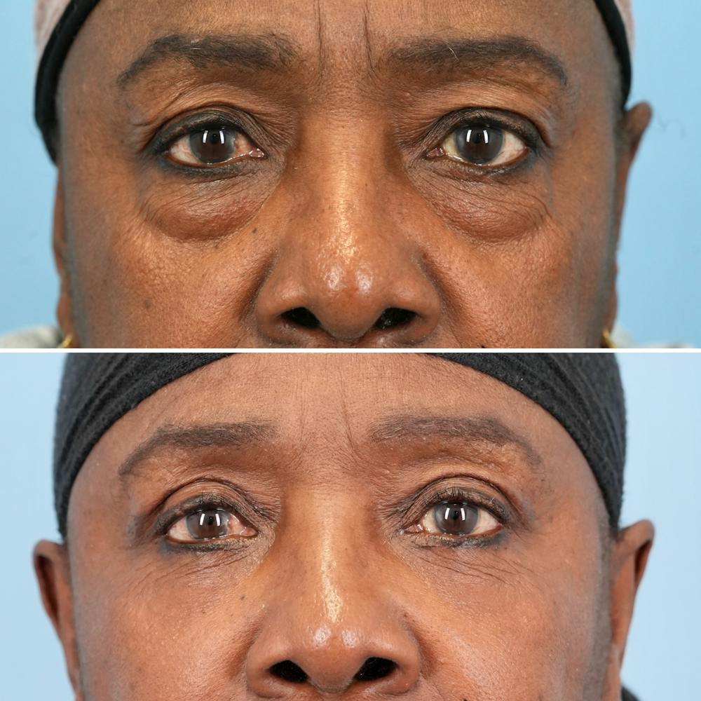Blepharoplasty Before & After Gallery - Patient 139445 - Image 1