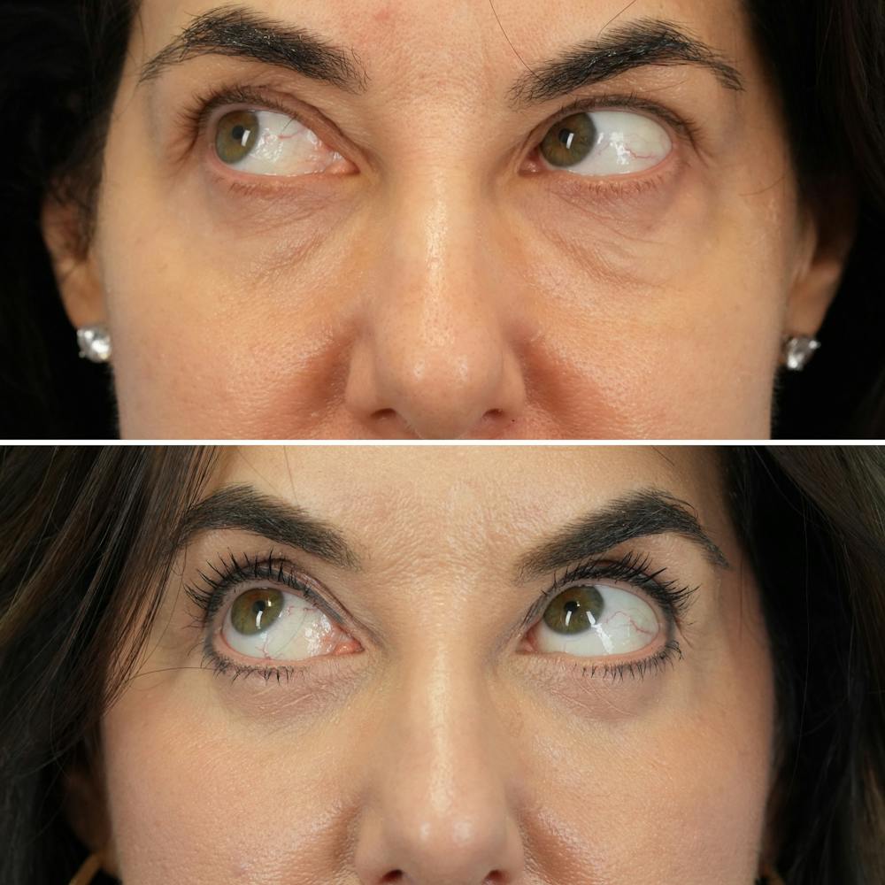 Blepharoplasty Before & After Gallery - Patient 323589 - Image 4