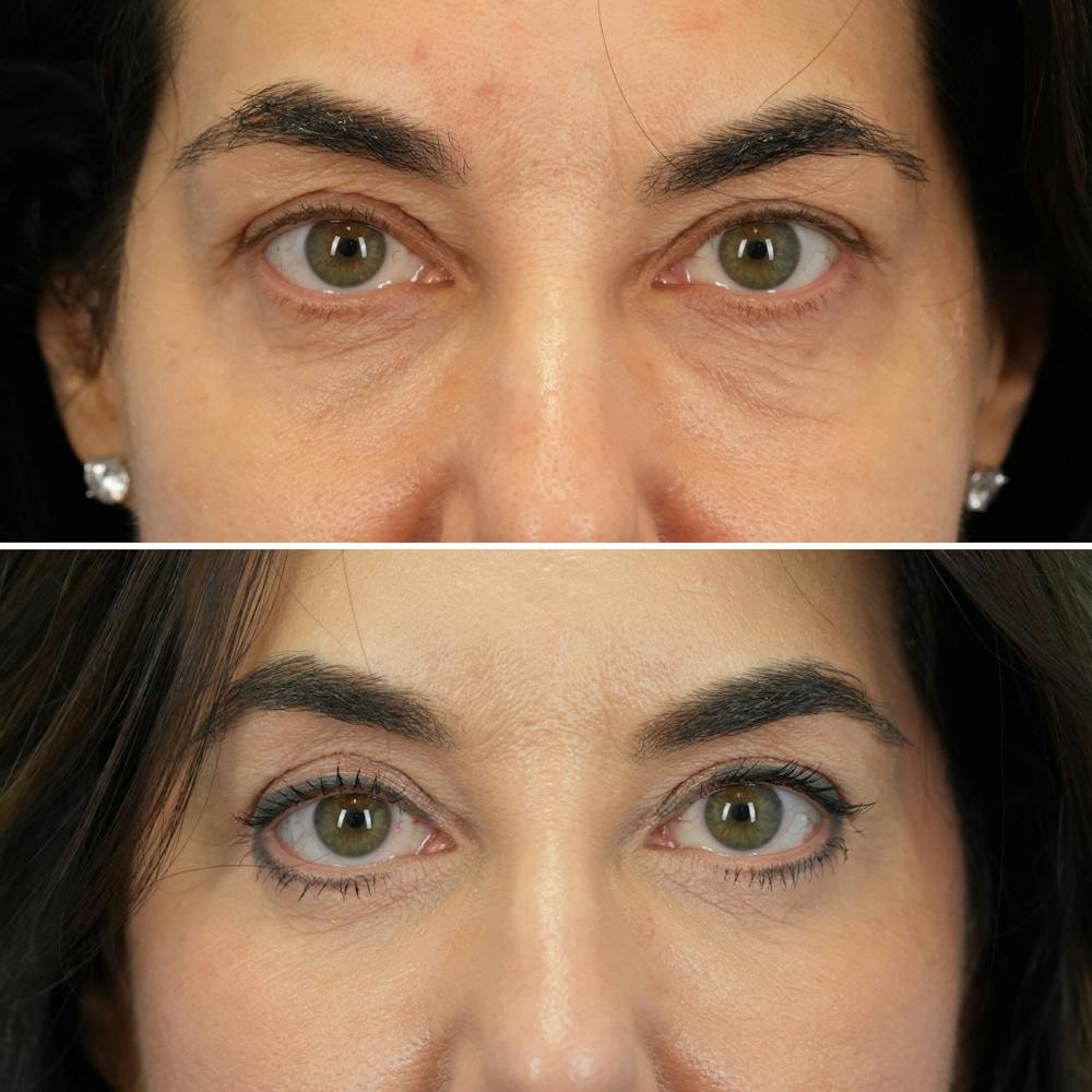 Blepharoplasty Before & After Gallery - Patient 323589 - Image 1