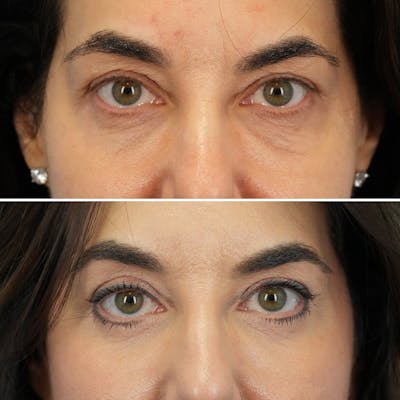 Blepharoplasty Before & After Gallery - Patient 323589 - Image 1