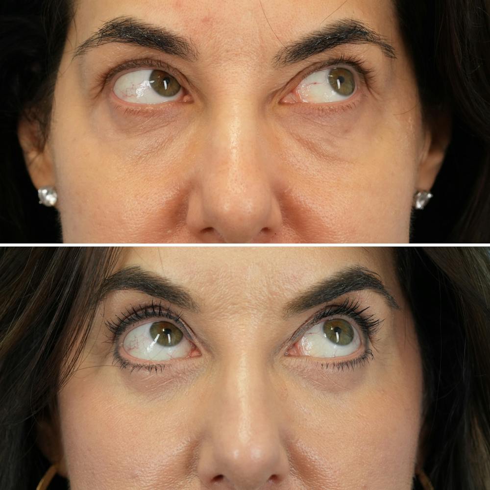 Blepharoplasty Before & After Gallery - Patient 323589 - Image 3
