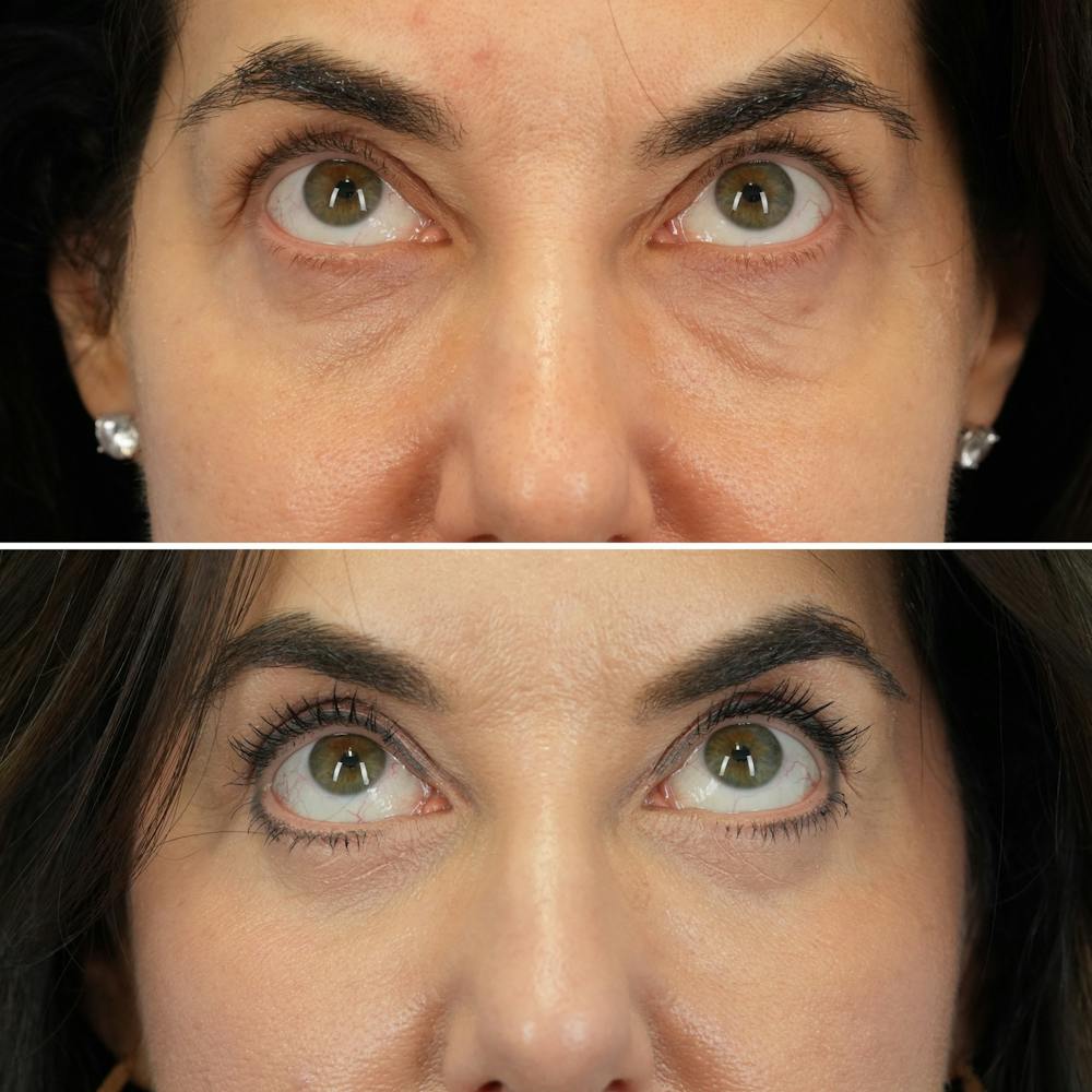 Blepharoplasty Before & After Gallery - Patient 323589 - Image 2