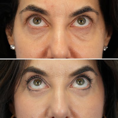 Blepharoplasty Before & After Gallery - Patient 323589 - Image 2