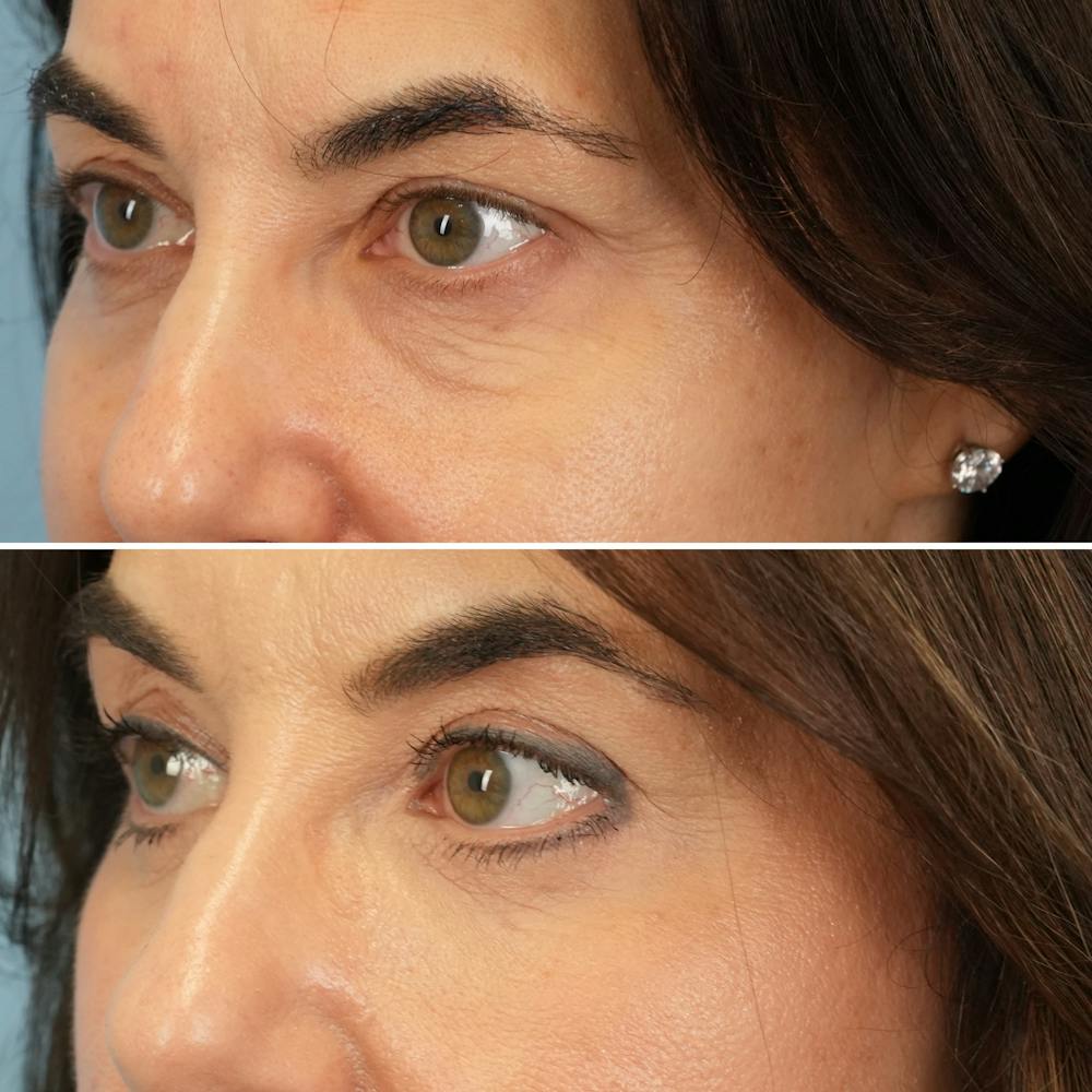 Blepharoplasty Before & After Gallery - Patient 323589 - Image 5