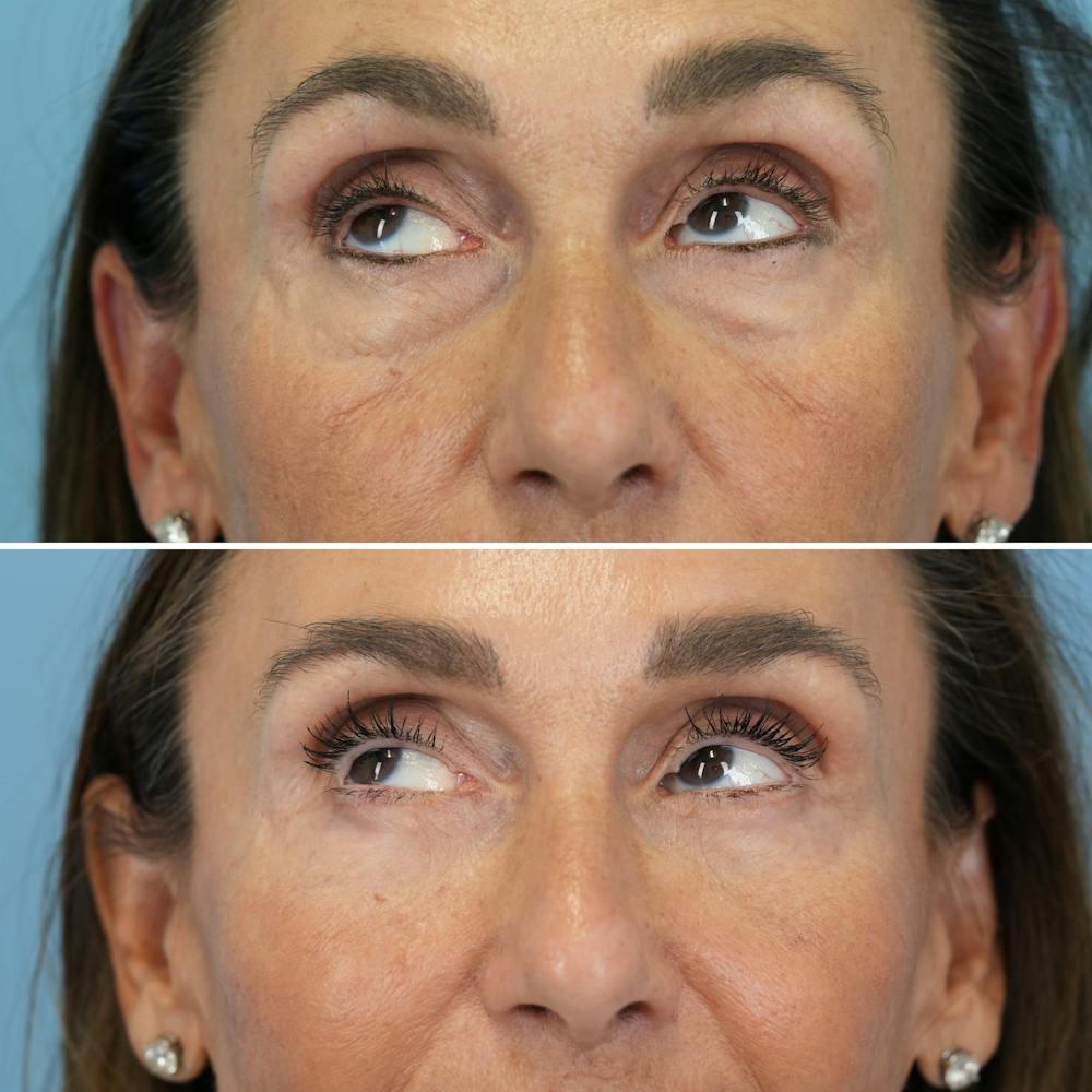 Blepharoplasty Before & After Gallery - Patient 270591 - Image 4
