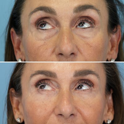 Blepharoplasty Before & After Gallery - Patient 270591 - Image 4