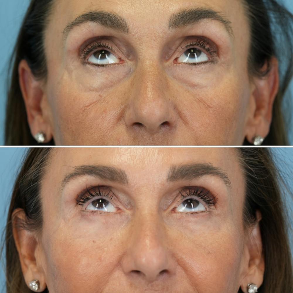 Blepharoplasty Before & After Gallery - Patient 270591 - Image 2