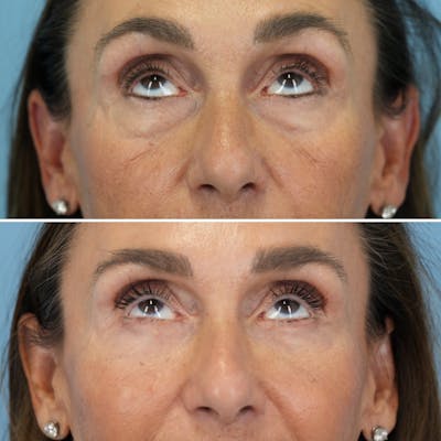 Blepharoplasty Before & After Gallery - Patient 270591 - Image 2