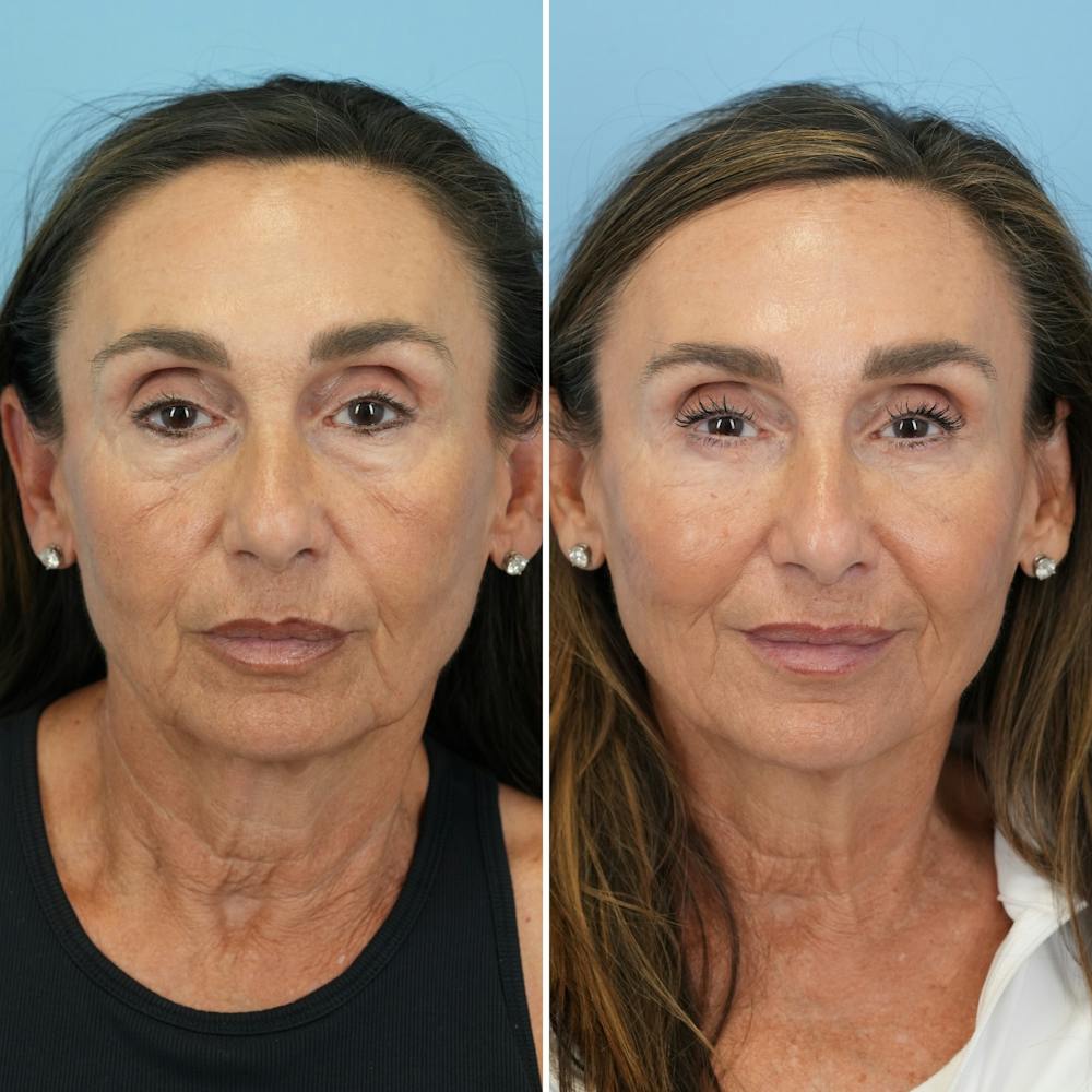 Blepharoplasty Before & After Gallery - Patient 270591 - Image 5