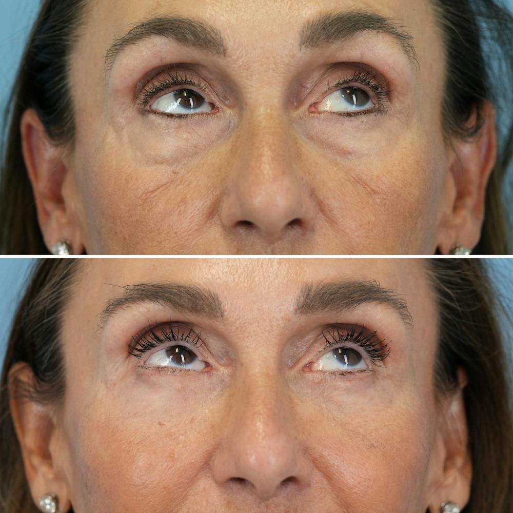 Blepharoplasty Before & After Gallery - Patient 270591 - Image 3