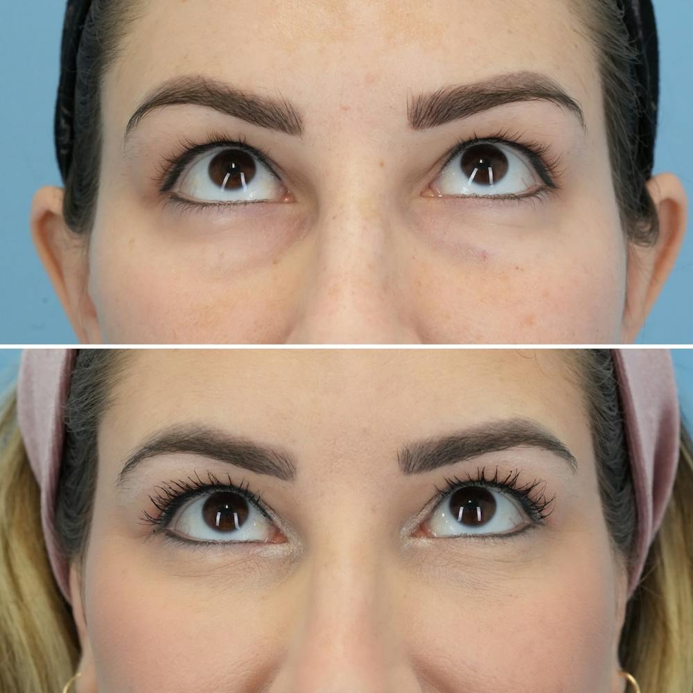 Blepharoplasty Before & After Gallery - Patient 220437 - Image 2