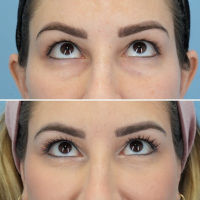 Blepharoplasty Before & After Gallery - Patient 220437 - Image 2